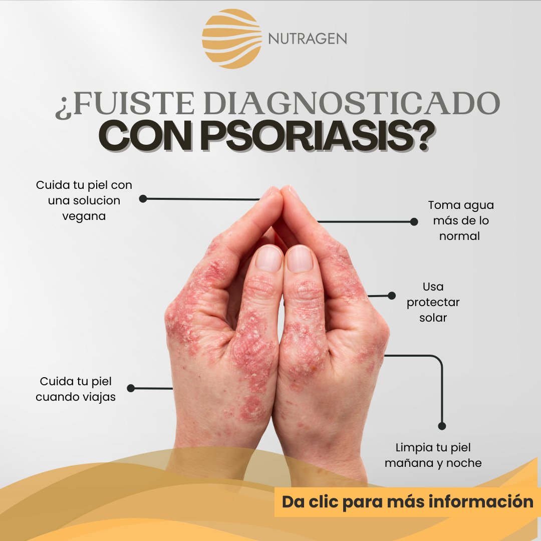 Psoriasis en manos — diagnóstico y tratamiento natural Nutragen