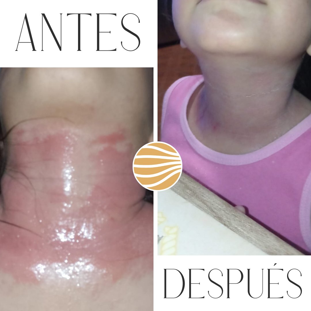 Antes y después Nutragen — psoriasis cuello niña, resultado visible