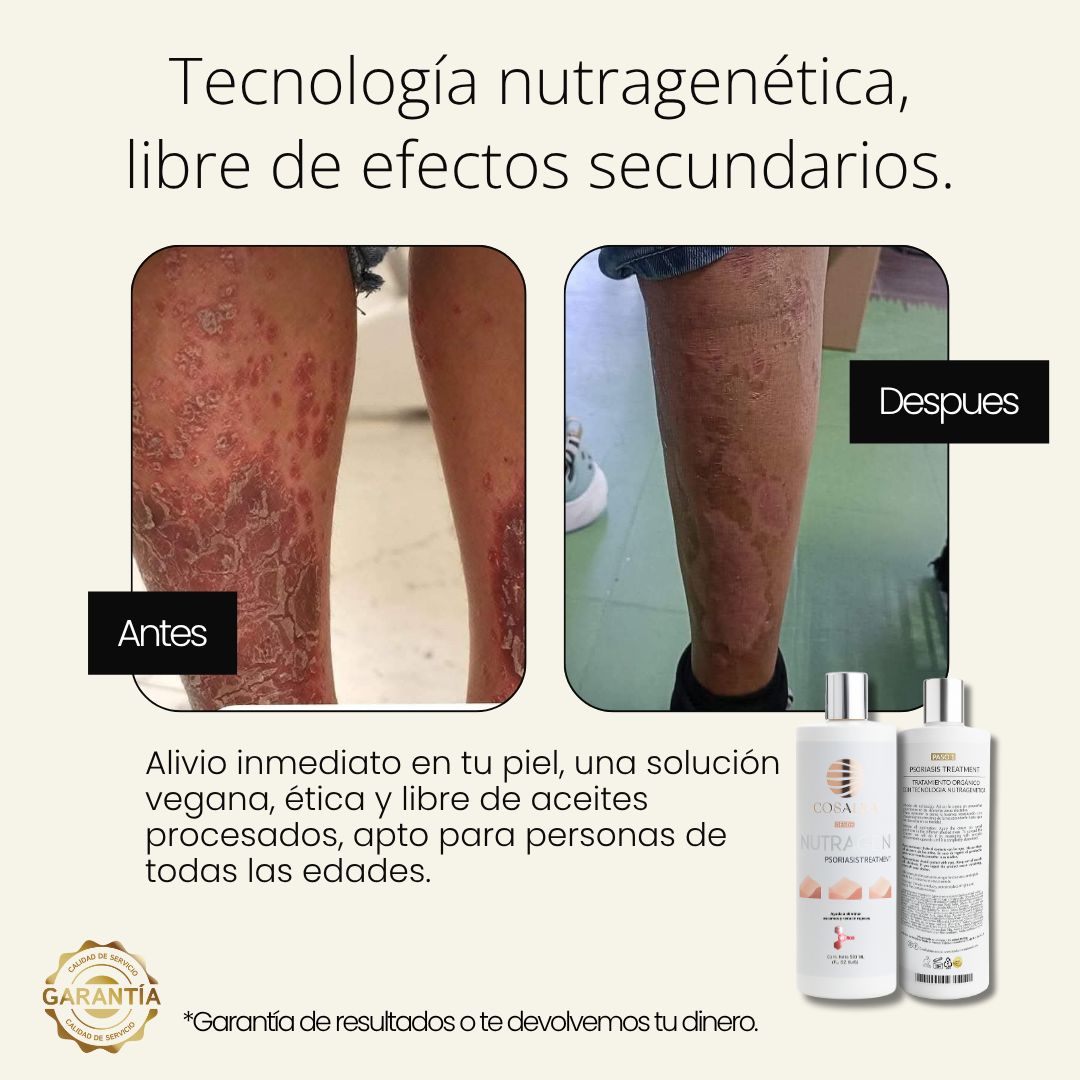 Antes y después Nutragen — psoriasis en piernas, resultado real