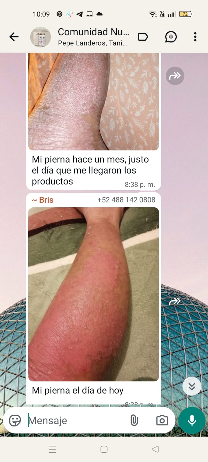Testimonio Bris — antes y después de usar Nutragen para psoriasis en pierna